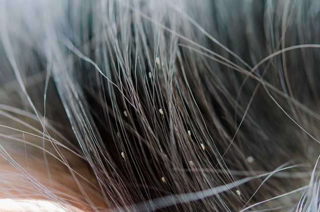 Berikut Ini Cara-Cara Alami Untuk Menghilangkan Kutu Rambut